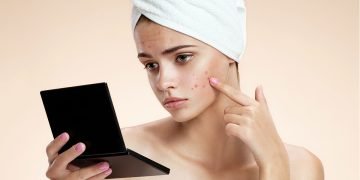 gode råd mod behandling af acne