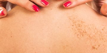 gode råd mod pigmentforandringer