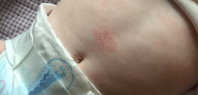 eksem hos 4 måneder gammel baby