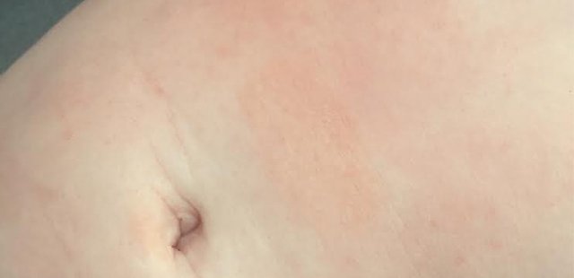 resultat af krokodilleolie mod eksem hos baby