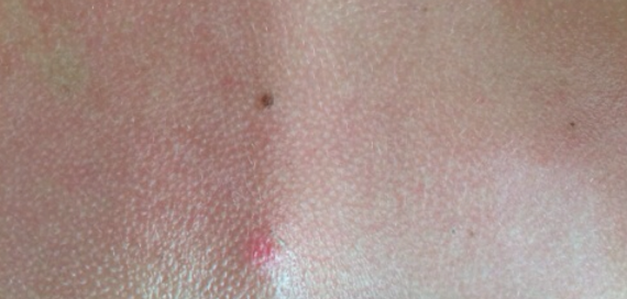 behandling med krokodilleolie mod solskoldning