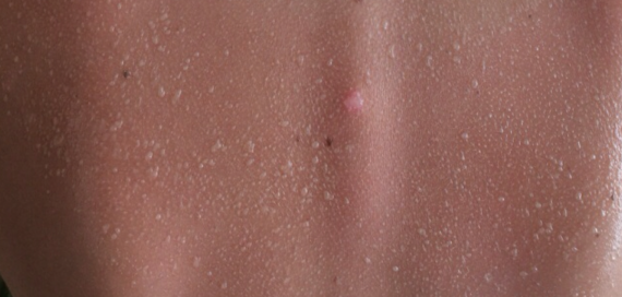 solskoldning med blærer